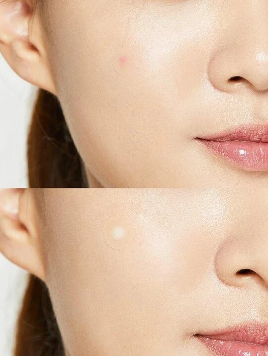 (COSRX) Acne Pimple Master Patch 1pcs